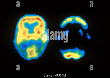 PET-Scans des Gehirns Normal und Alzheimer Stockfoto