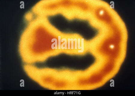 PET-Scan des normalen Gehirn Stockfoto