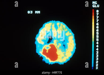 PET-Gehirn-Scan, bösartigen Tumor Stockfoto