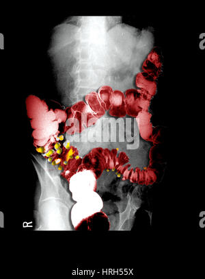 Barium Enema zeigt Divertikulose Stockfoto