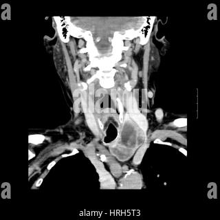 CT der Hals zeigt Schilddrüse Struma Stockfoto