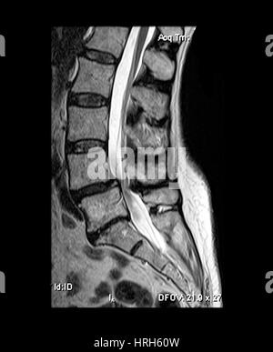 Spondylolisthesis & Kanal-Stenose Stockfoto