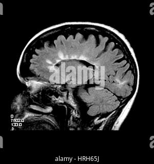 MRT der multiplen Sklerose Stockfoto