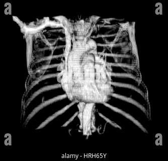 3D CT-Rekonstruktion des Herzens Stockfoto