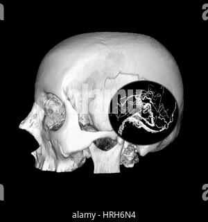 3D Bild des Schädels und Gehirns AVM Stockfoto