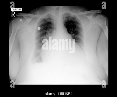 Vergrößertes Herz auf Röntgen-Thorax Stockfoto