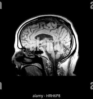 MRI des Alkoholismus im Zusammenhang mit Vermian Atrophie Stockfoto