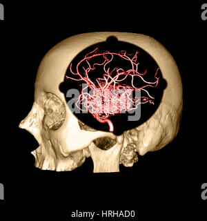 3D Bild des Schädels und Gehirns AVM Stockfoto