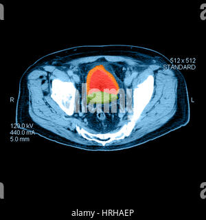 CT von Prostata-Krebs Stockfoto