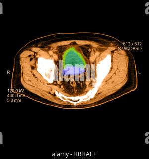 CT von Prostata-Krebs Stockfoto