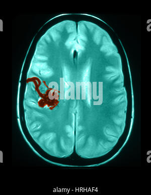 MRI des arteriellen und venösen Fehlbildungen Stockfoto