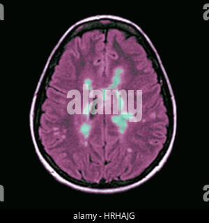MRT der multiplen Sklerose Stockfoto