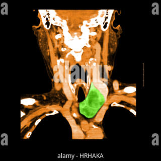 CT der Hals zeigt Schilddrüse Struma Stockfoto