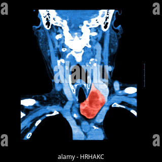 CT der Hals zeigt Schilddrüse Struma Stockfoto