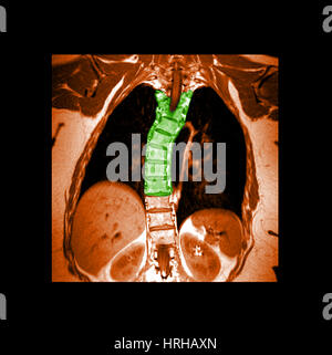MRT der thorakalen Skoliose Stockfoto