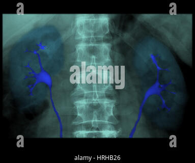 IVP normale Nieren Stockfoto
