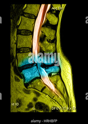 Spondylolisthesis & Kanal-Stenose Stockfoto