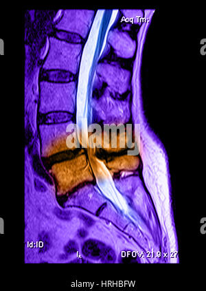 Spondylolisthesis & Kanal-Stenose Stockfoto