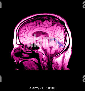 MRI des Alkoholismus im Zusammenhang mit Vermian Atrophie Stockfoto