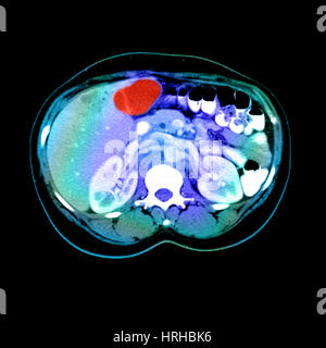 CT-Scan ein Lebertumor Stockfoto