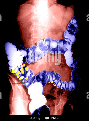 Barium Enema zeigt Divertikulose Stockfoto