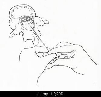 Illustration der Lumbalpunktion (Lumbalpunktion) Stockfoto