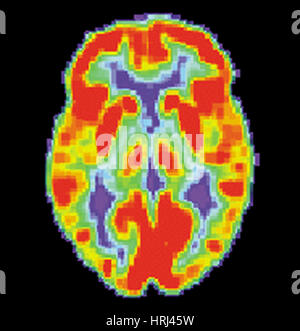 PET-Scan des Gehirns Normal, 1 von 2 Stockfoto