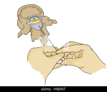 Illustration der Lumbalpunktion (Lumbalpunktion) Stockfoto