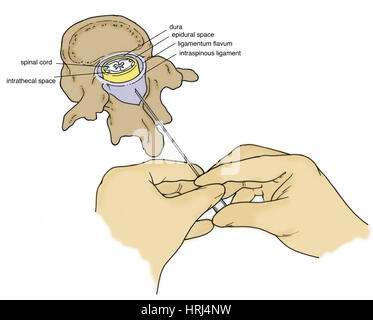 Illustration der Lumbalpunktion (Lumbalpunktion) Stockfoto