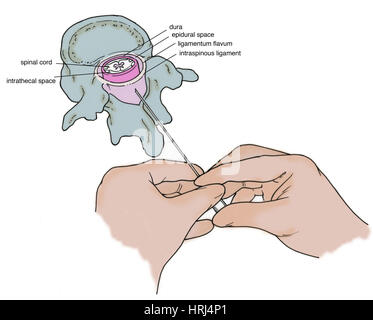 Illustration der Lumbalpunktion (Lumbalpunktion) Stockfoto