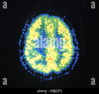 PET-Scan des normalen Gehirn Stockfoto