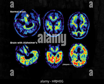 Normal und Alzheimer Gehirn, PET-Scans Stockfoto