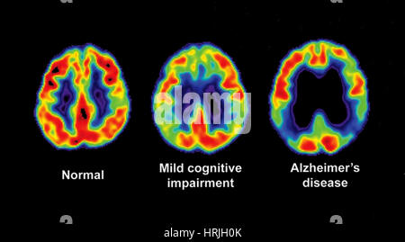 Normal, beeinträchtigt und Alzheimer Gehirn PET-Scans Stockfoto