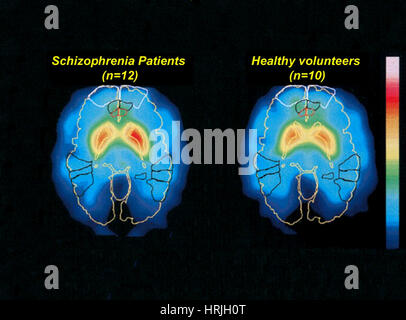 Schizophrenie und normale Gehirn, PET-Scans Stockfoto