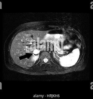 Nebennieren Phäochromozytom, MRI Stockfoto