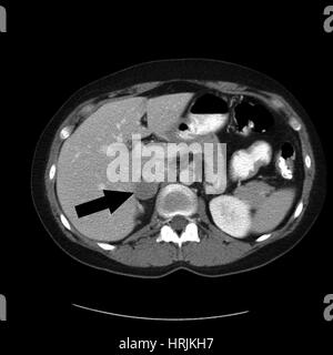 Nebennieren Phäochromozytom, CT Stockfoto