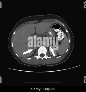 Von Hippel-Lindau Phäochromozytom, CT Stockfoto