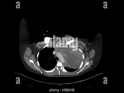 Sternale Metastasierung von Melanom, CT Stockfoto