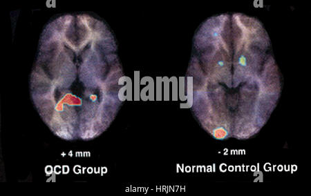 PET-Scan, Normal und OCD Gehirn Stockfoto