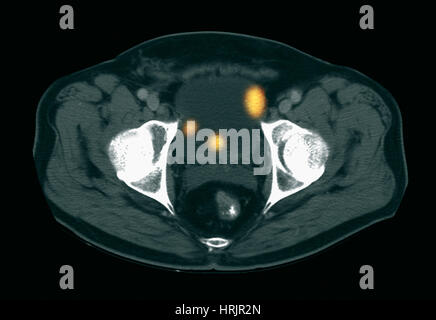 Blase Krebs, CT-Scan Stockfoto