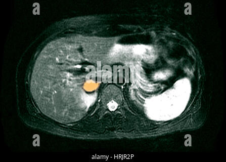 Nebennieren Phäochromozytom, MRI Stockfoto