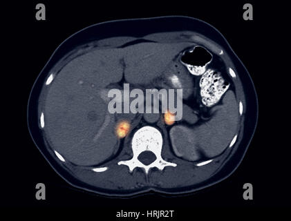 Von Hippel-Lindau Phäochromozytom, CT Stockfoto