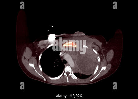 Sternale Metastasierung von Melanom, CT Stockfoto