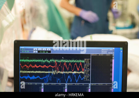 Monitor zeigt Herz Pulsfrequenz Spuren während des Betriebs. Stockfoto