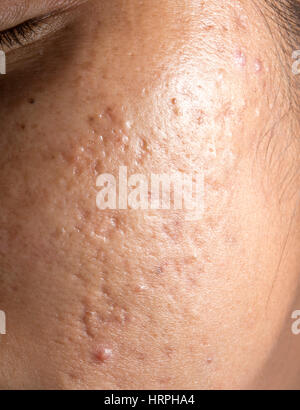 Frauen mit Closeup problematische Haut und Akne-Narben Stockfoto