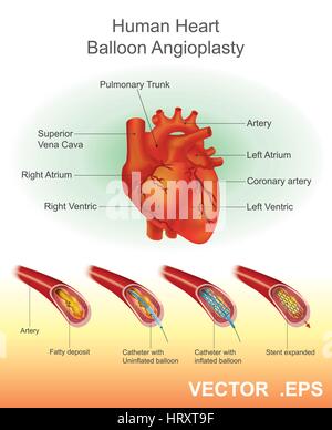 Angioplastie (oder Ballondilatation) ist eine endovaskuläre Verfahren erweitern verengt oder verstopft Arterien oder Venen, in der Regel zur Behandlung von arteriellen ather Stock Vektor