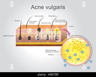 Akne Vulgaris ist eine langfristige Hautkrankheit, die auftritt, wenn Haarfollikel mit abgestorbenen Hautzellen und Öl von der Haut verstopfen. Akne ist Charakter Stock Vektor