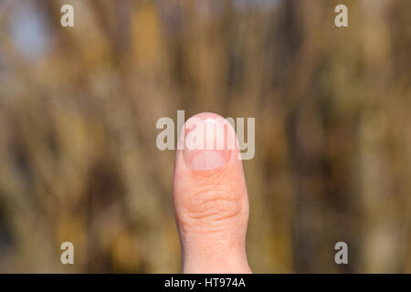 Gespaltener Nagel am Daumen. Dilatation des Nagels, traumatische Pathologie. Der Nagel ist in zwei Hälften unterteilt. Stockfoto