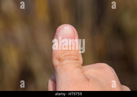 Gespaltener Nagel am Daumen. Dilatation des Nagels, traumatische Pathologie. Der Nagel ist in zwei Hälften unterteilt. Stockfoto