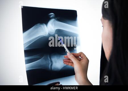 Blick auf das x-ray Bild Knie im Krankenhaus Arzt Stockfoto